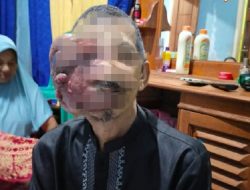 Penderita Kanker di Wajah Butuh Uluran Tangan
