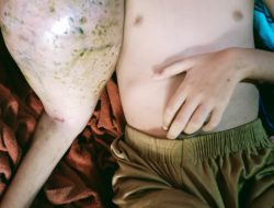 Usai Vaksinasi di Sekolah, Siska Alpiah Mengeluarkan Benjolan Besar di Tangan